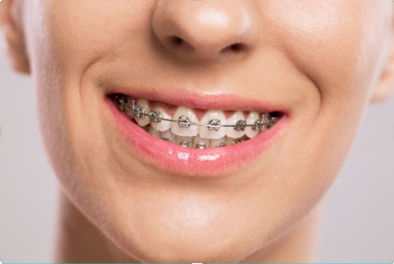 ortodoncia-brackets