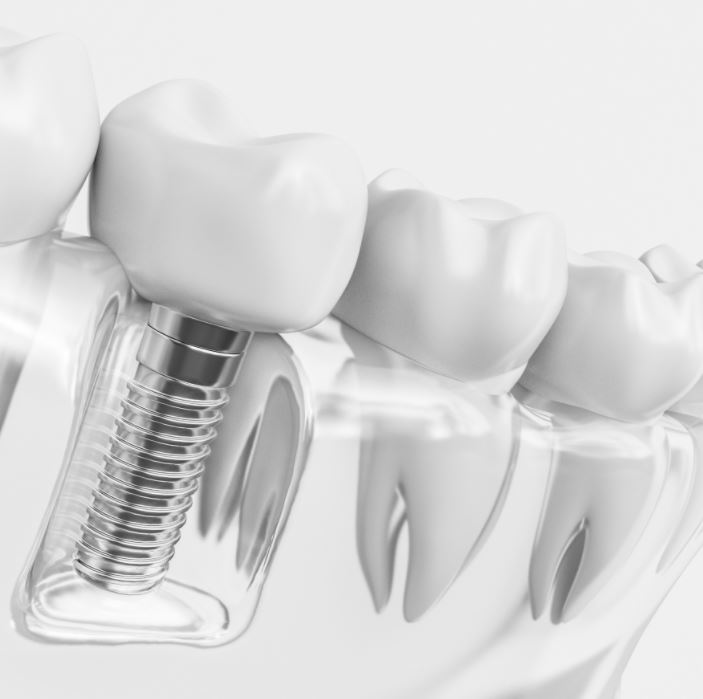 Implantes dentales en Barcelona