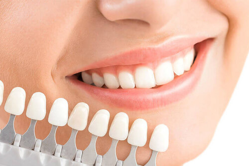 Sabe cómo se colocan las carillas dentales sin desgaste? - Estética dental