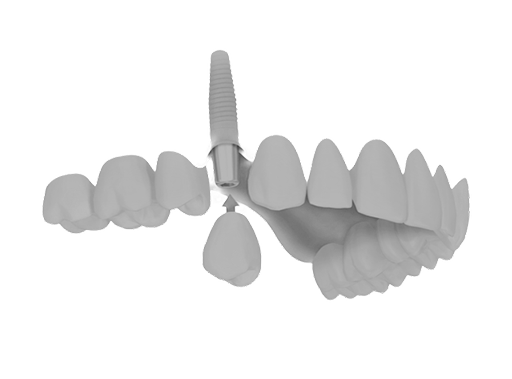 implantes-dentales-clinica-dental-care-barcelona