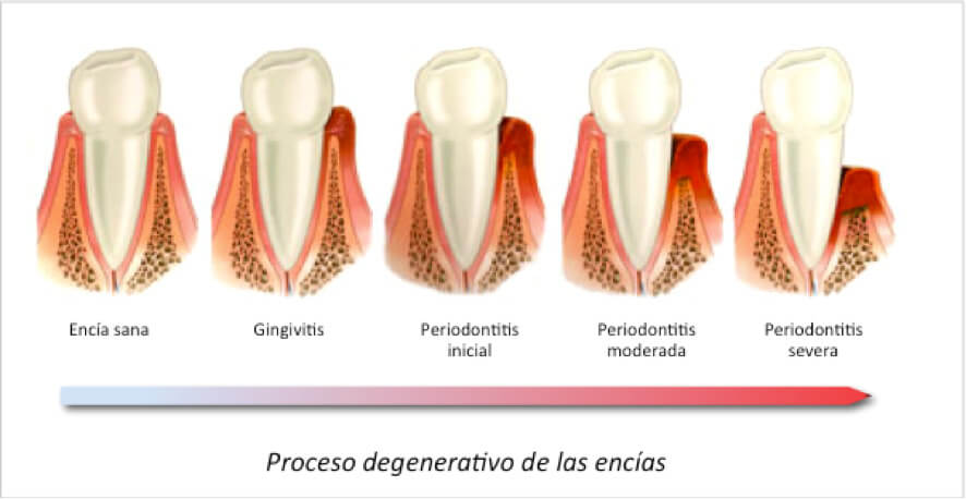 periodontitis-fases