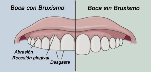 bruxismo-solucion