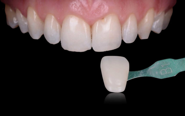 blanqueamiento-luz-led-dental-care-barcelona blanqueamiento-luz-led-dental-care-barcelona