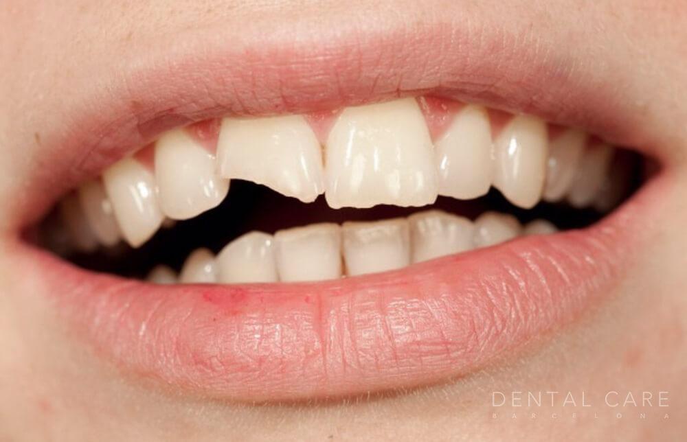 Qué hacer cuando se sufre una fractura dental