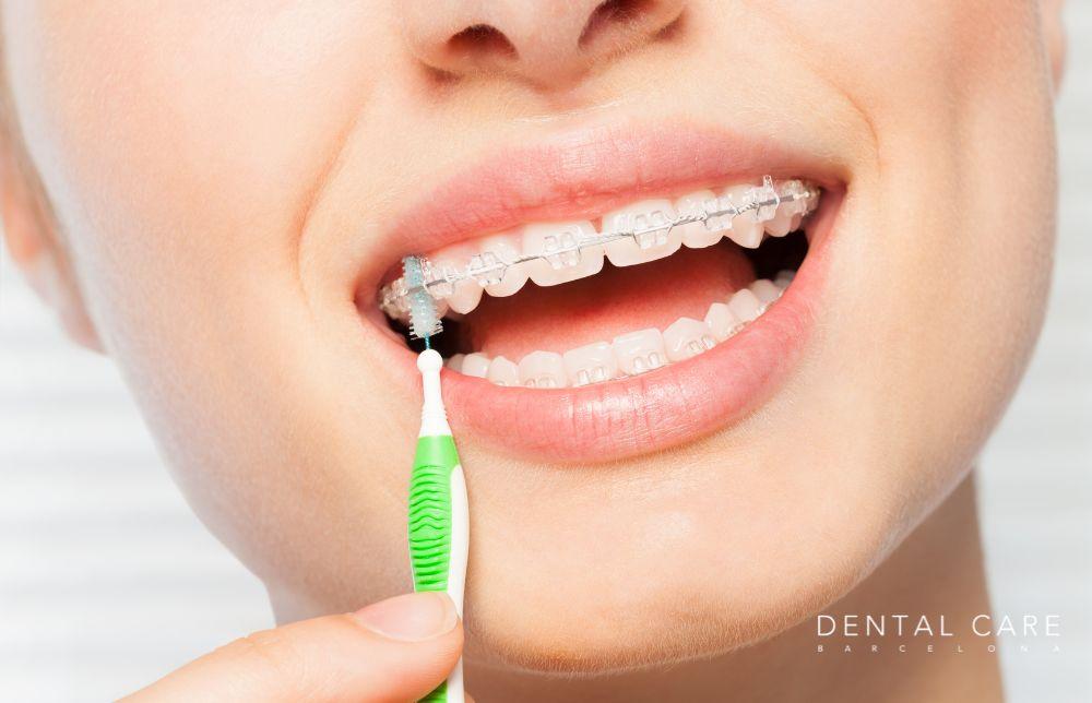 Consejos para una óptima higiene durante la ortodoncia