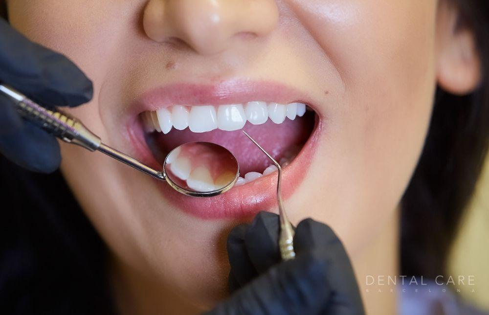 Carillas dentales como solución para la periodontitis