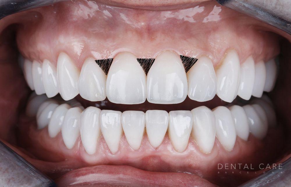 Carillas dentales: La solución estética para cerrar triángulos y espacios negros