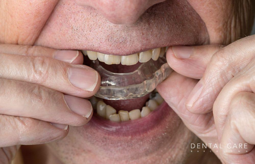 Dientes desgastados: Causas, síntomas y tratamientos