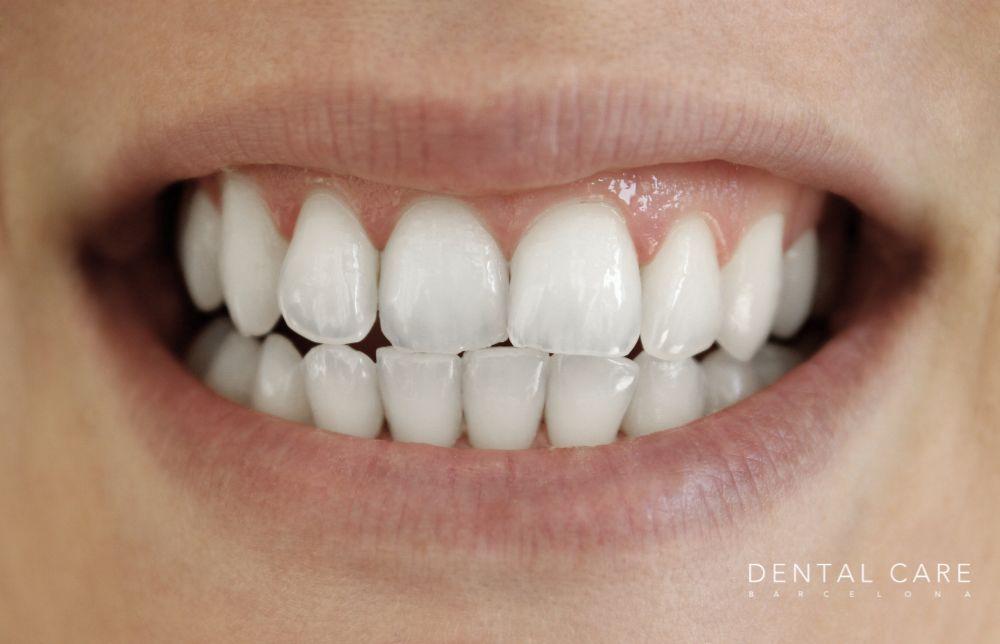 Descubre los beneficios del composite en estética dental
