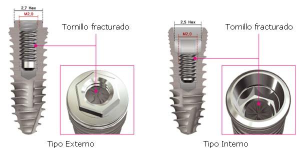 conexion-implantes-externo-interno