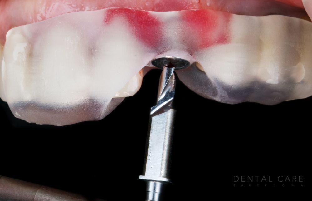 Tipos de conectores utilizados en implantes dentales