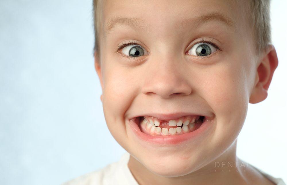¿Qué es la agenesia dental y cómo afecta a tu sonrisa?