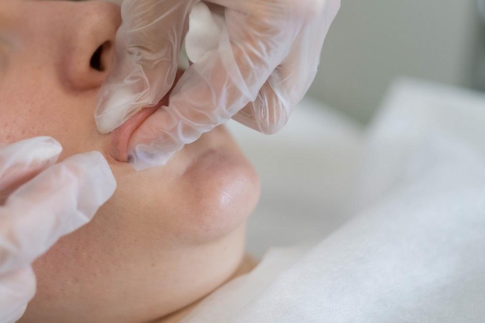 queilitis-angular-clinica-dental-barcelona